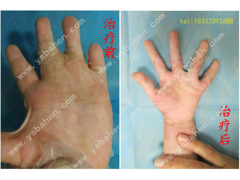 手指挛缩畸形2_不植皮治疗疤痕粘连,不植皮治疗烧伤
